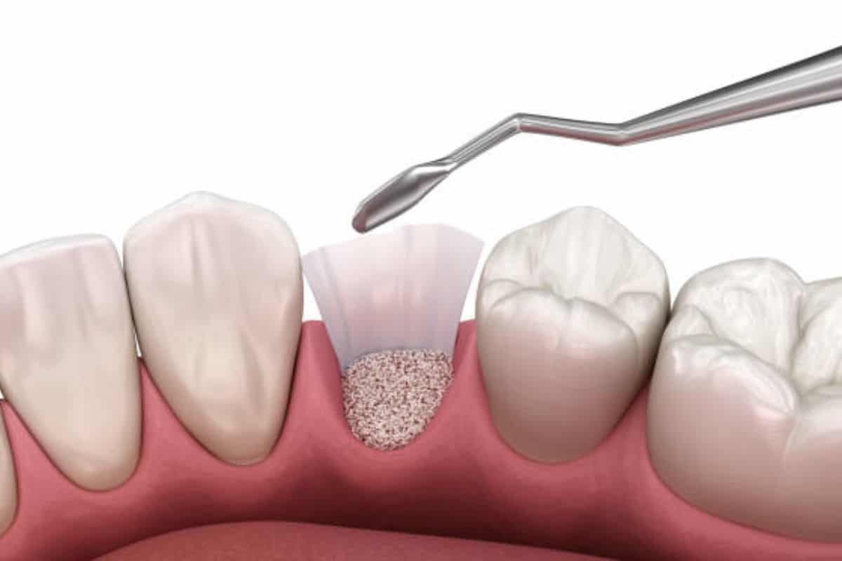 Bone Grafting Recovery