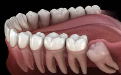 Tooth Extraction: Cost, Procedure, Risks, and Recovery