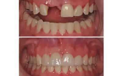 What Makes Dental Implants the Most Natural Tooth Replacement Option?