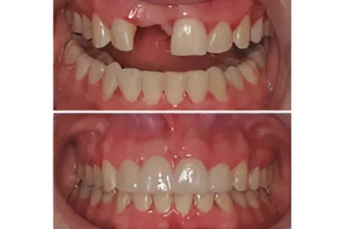 Dental Implants the Most Natural Tooth Replacement Option