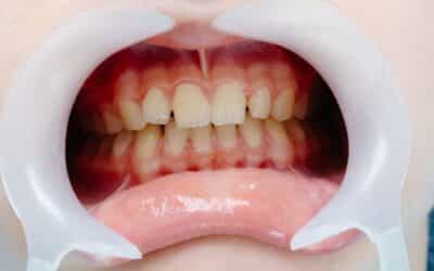 The Future of Gum Regeneration: How LANAP and Pinhole Techniques Are Changing Dentistry