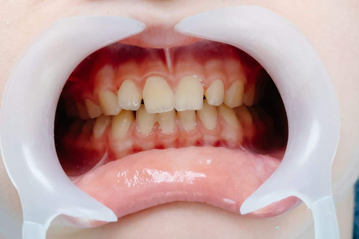 Gum Regeneration: How LANAP and Pinhole Techniques Are Changing Dentistry