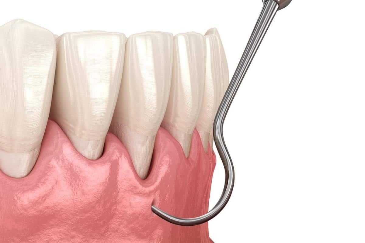 Pinhole Gum Rejuvenation