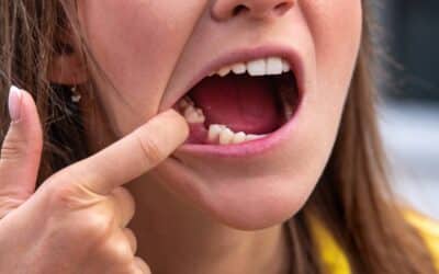 Preventing Bone Loss After Tooth Extraction: Tips from Dental Experts