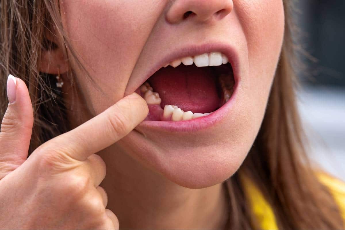 Prevent Bone Loss After Tooth Extraction