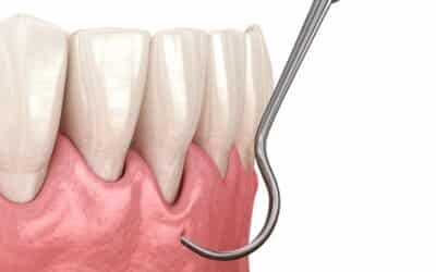 Pinhole Gum Rejuvenation Cost, Recovery, and Benefits Explained