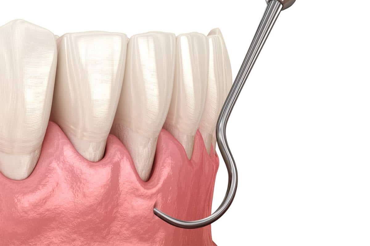 Pinhole Gum Rejuvenation