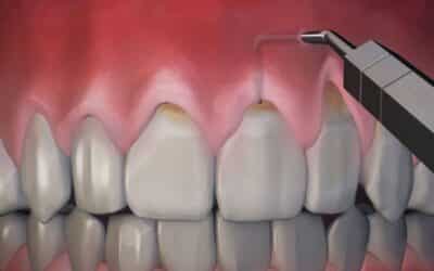 Before And After Pinhole Gum Surgery: Real Results And What To Expect