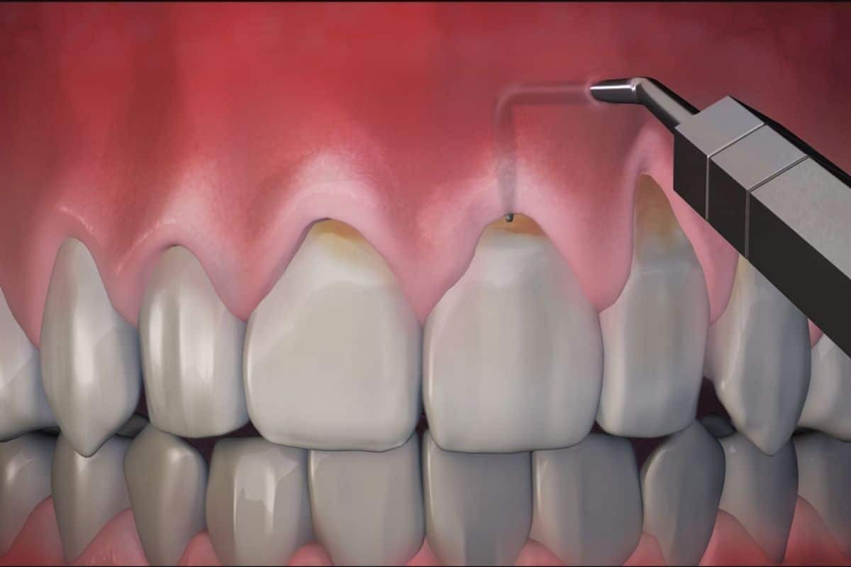 Pinhole Gum Surgery