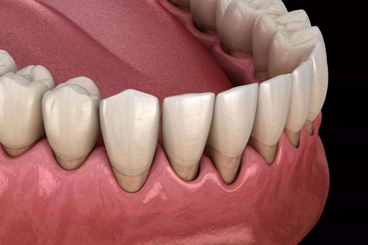 Expert Periodontal Recall in Phoenix