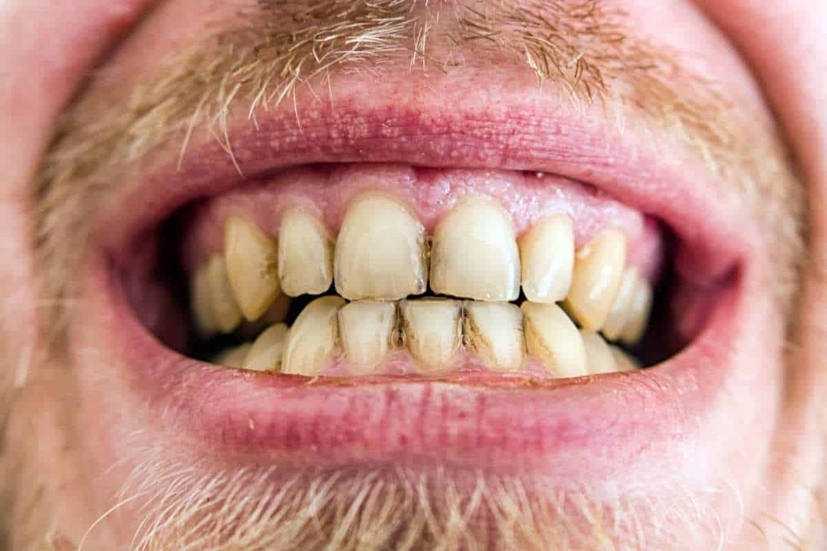 Why Plaque Builds Up After Brushing–Phoenix Periodontist Tips Why Plaque Builds Up After Brushing