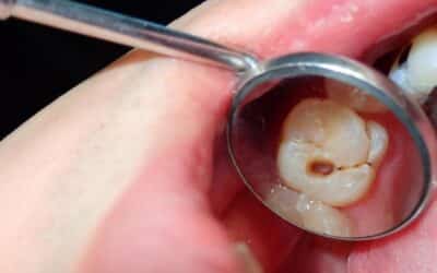 Can You Reverse a Cavity Without a Filling? What a Dentist Says