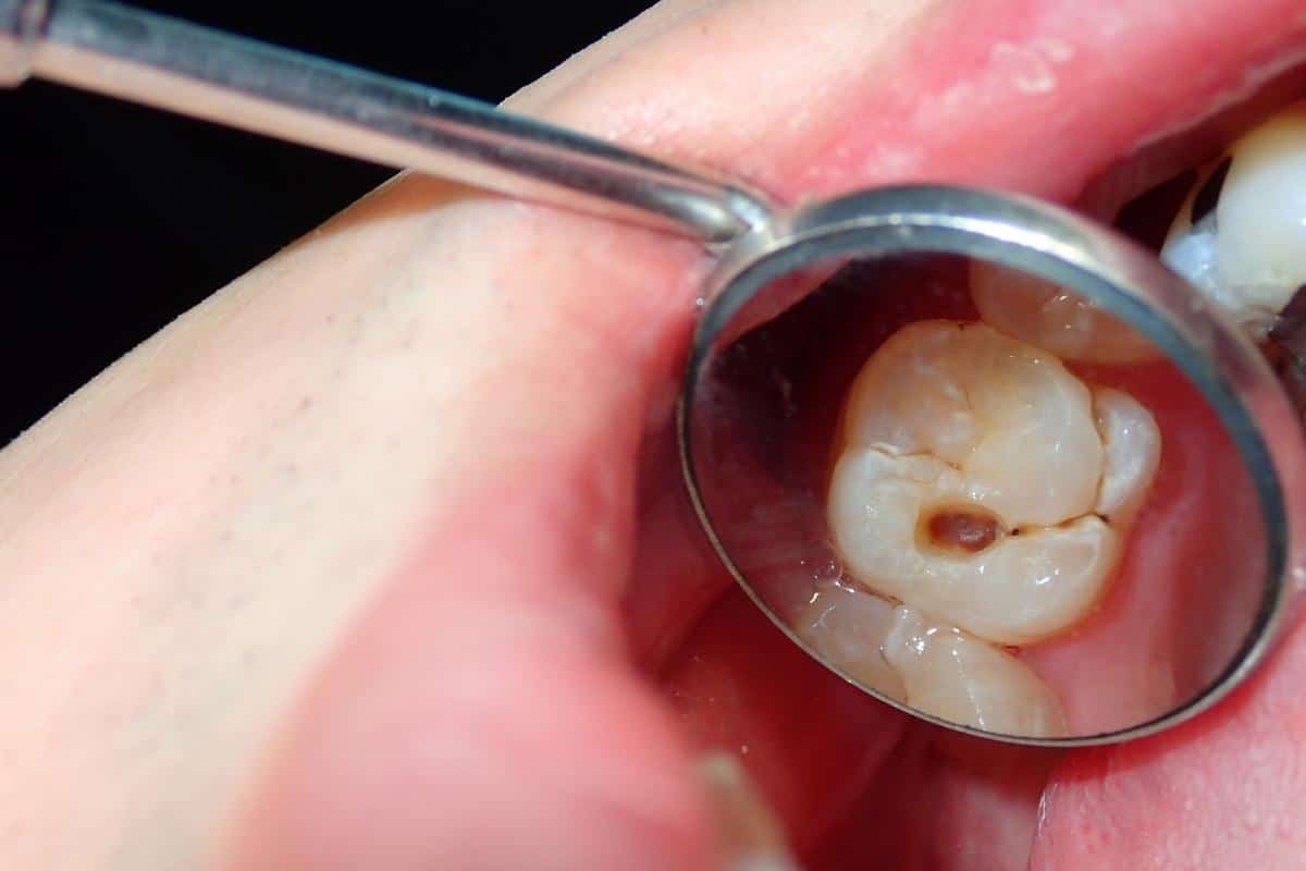 Do Cavities Heal Naturally? What Dentists Want You to Know