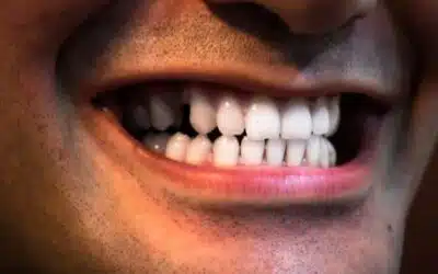 Dental Replacement Options Explained: Implants, Bridges, or Dentures—Which Is Right for You?