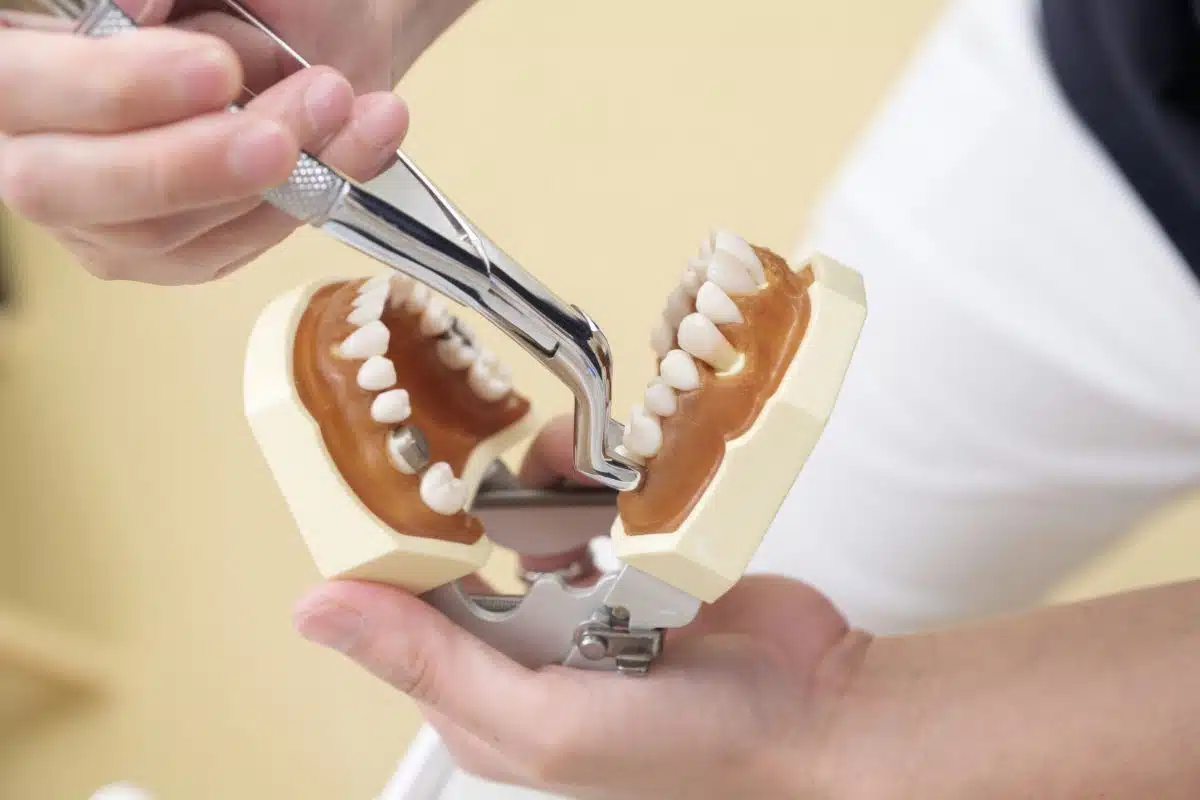 Tooth extraction impact on jawbone